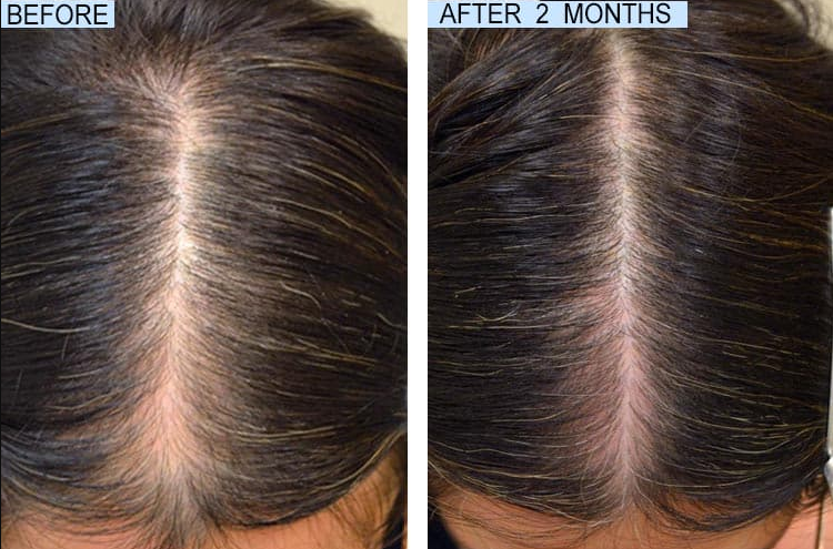 FullyVital Hair Growth System before and after